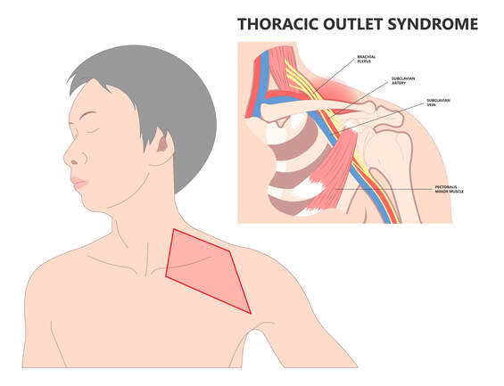 Diagram of thoracic outlet syndrome and the nerves in the brachial plexus from the neck to shoulder.  