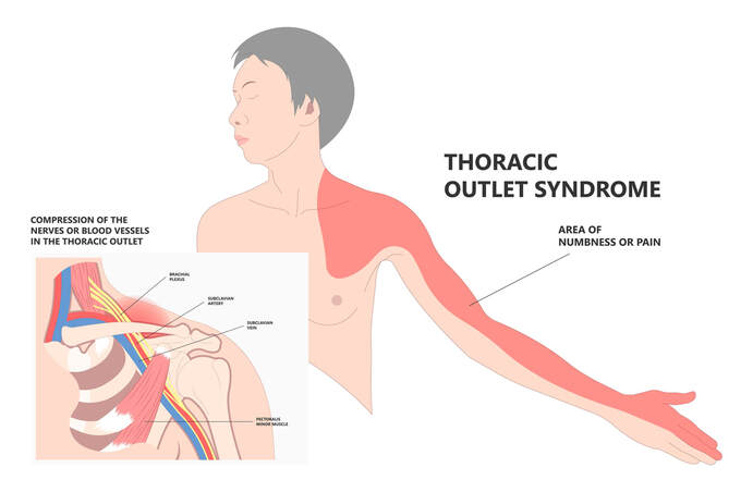 Diagram of thoracic outlet syndrome, the brachial plexus nerves, and highlighting the affected areas around the shoulder, arm, and hand (thumb, forefinger, and second finger).